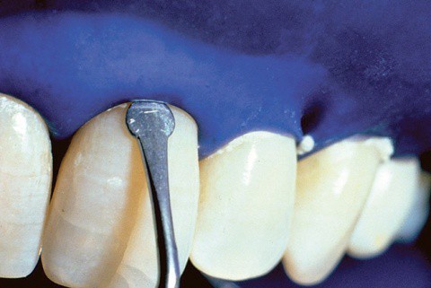 Curacion estetica- dentista ica