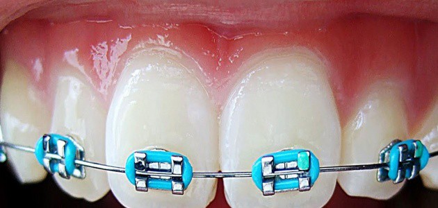 dentista ica brackets