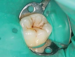 swissdent endodoncia dentista ica